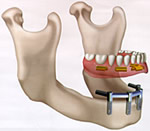 Removable Dentures Two